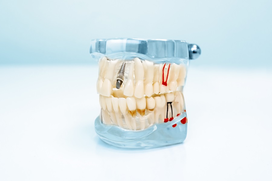 Should I take Antibiotics Before my Dental Procedure if I have an Orthopaedic Implant?